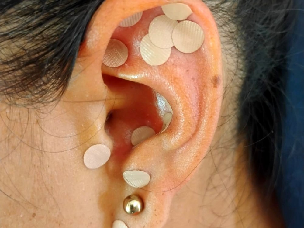 Sesión de auriculoterapia, oído con semillas de tratamiento